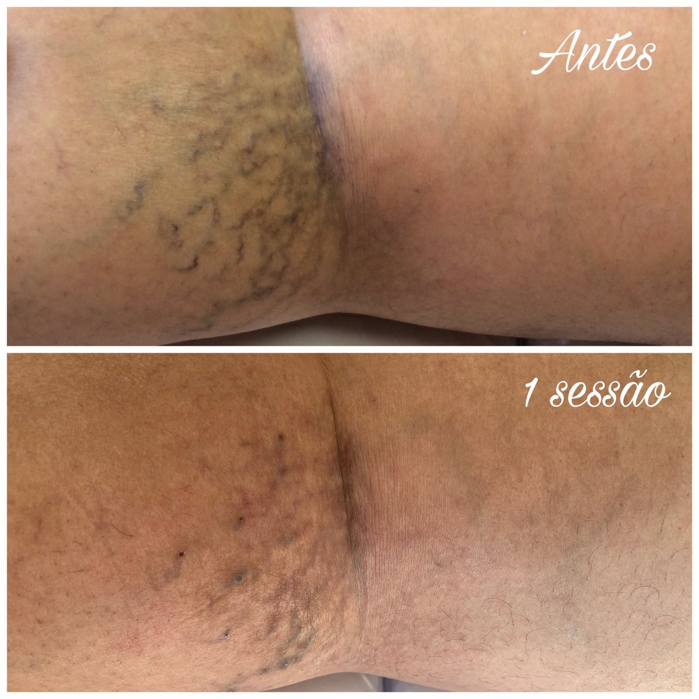 Aplicação em varizes / microvasos