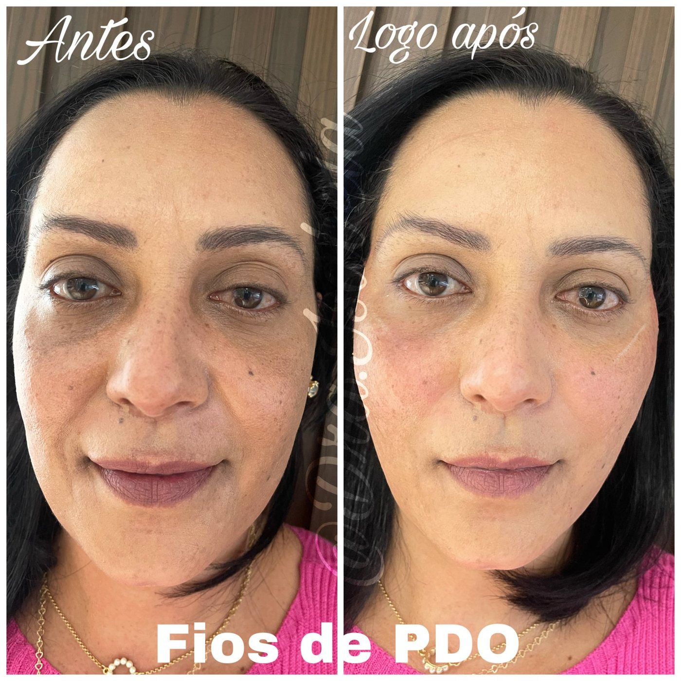 Fios de PDO