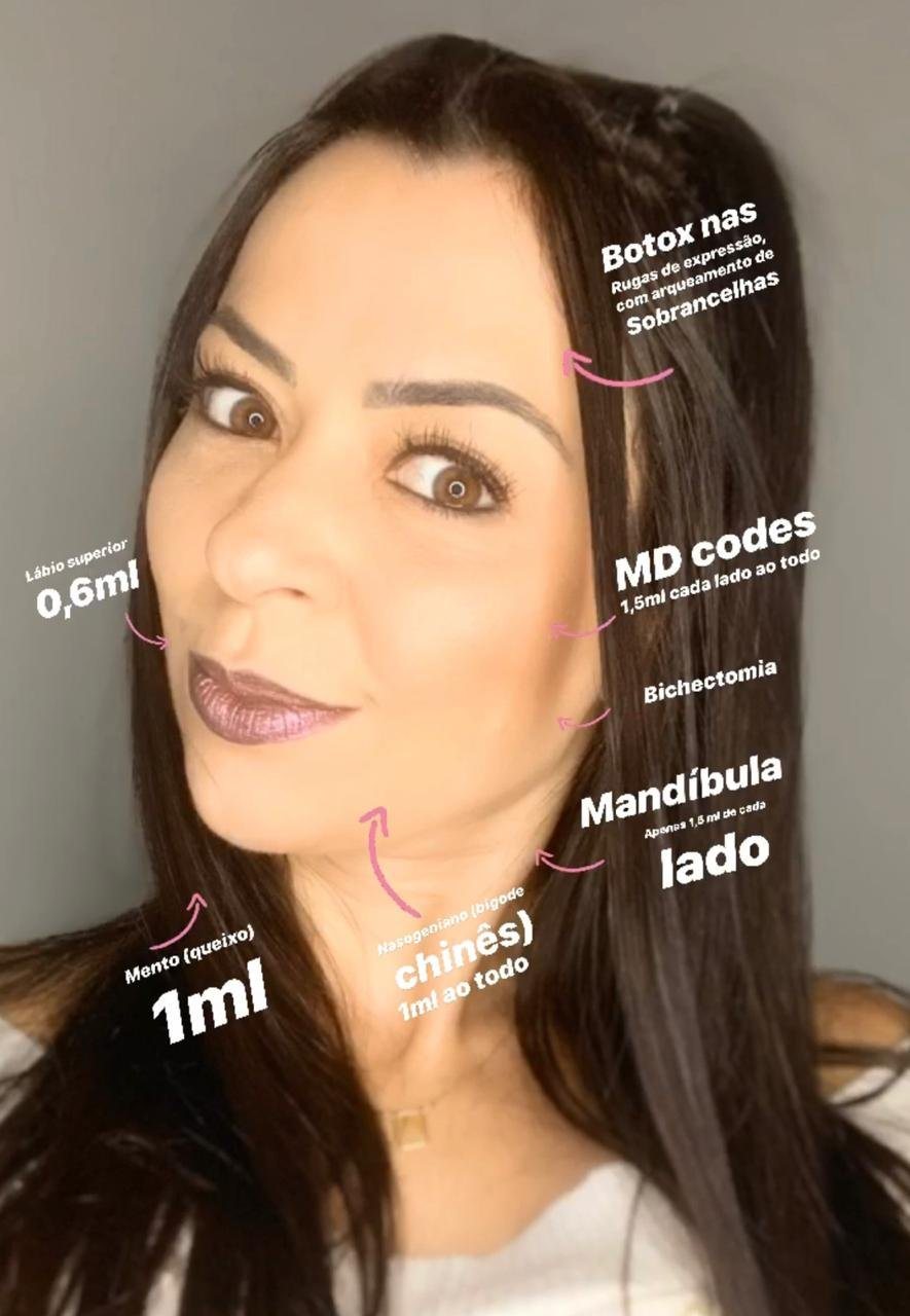 Harmonização Facial
