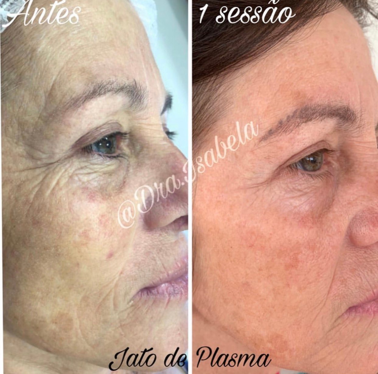 Jato de plasma