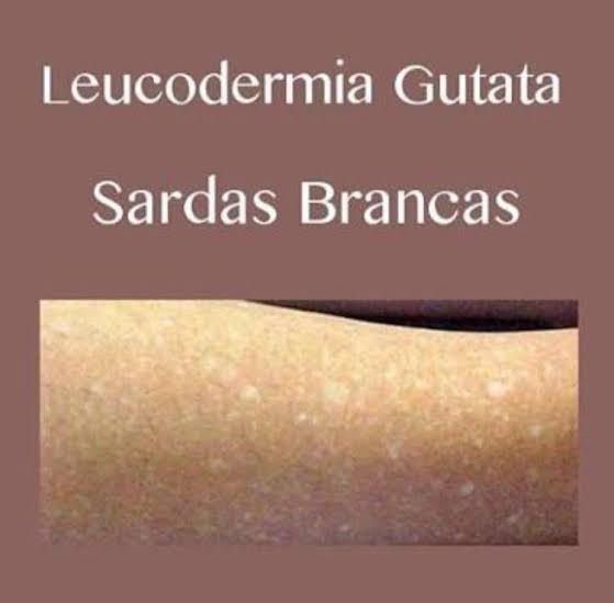Leucodermia Gutata (manchas brancas na pele)