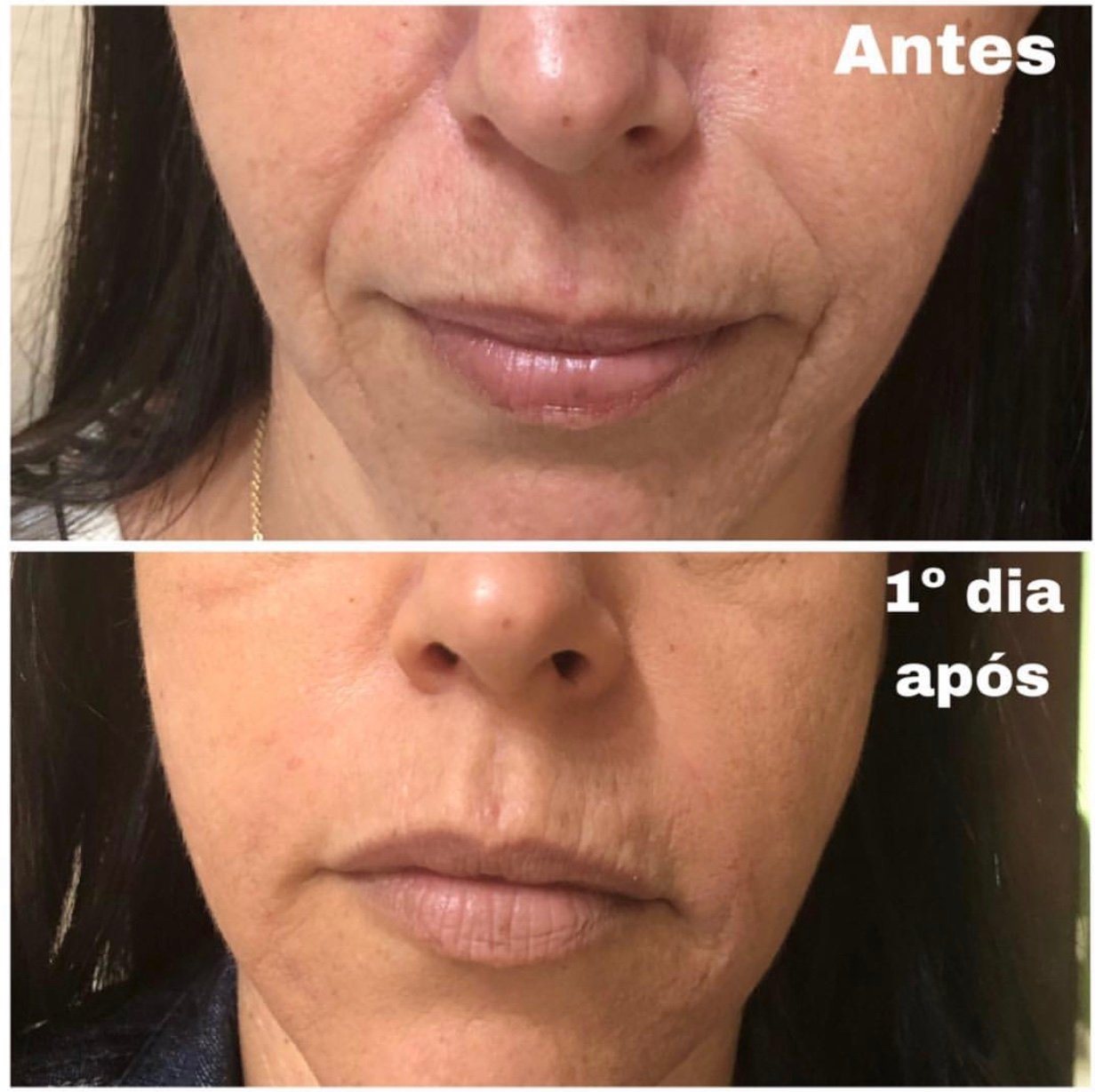 Preenchimento Bigode Chinês / nasogeniano