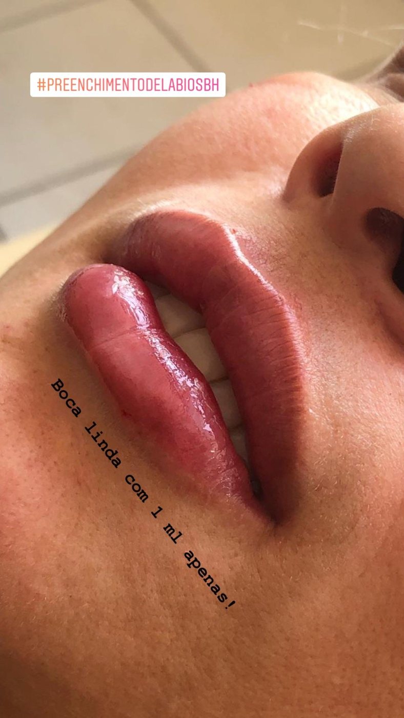 Preenchimento labial