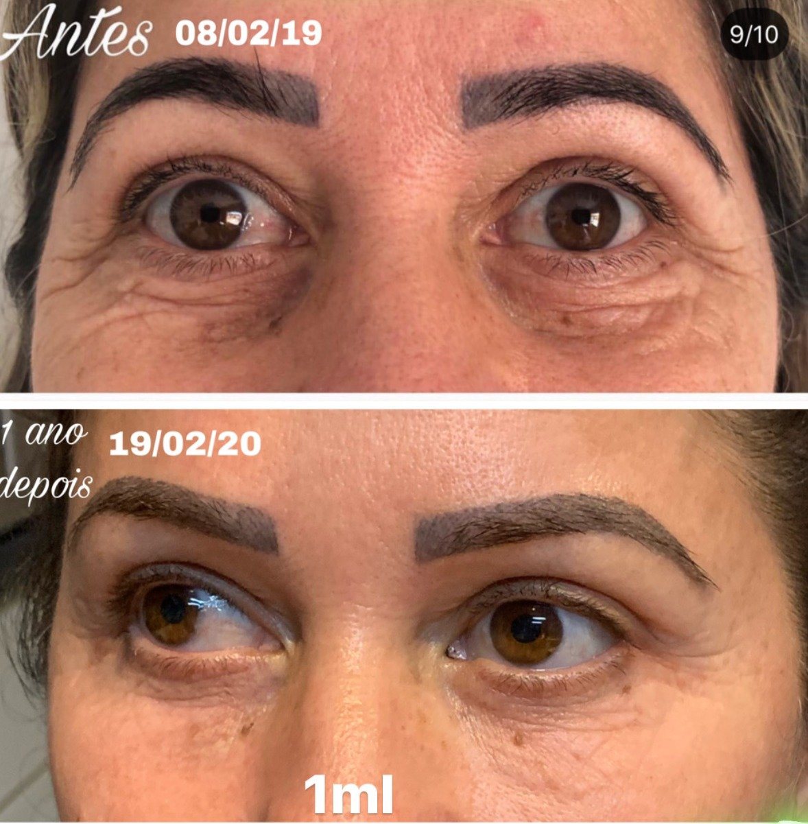 Preenchimento olheiras / calha lacrimal