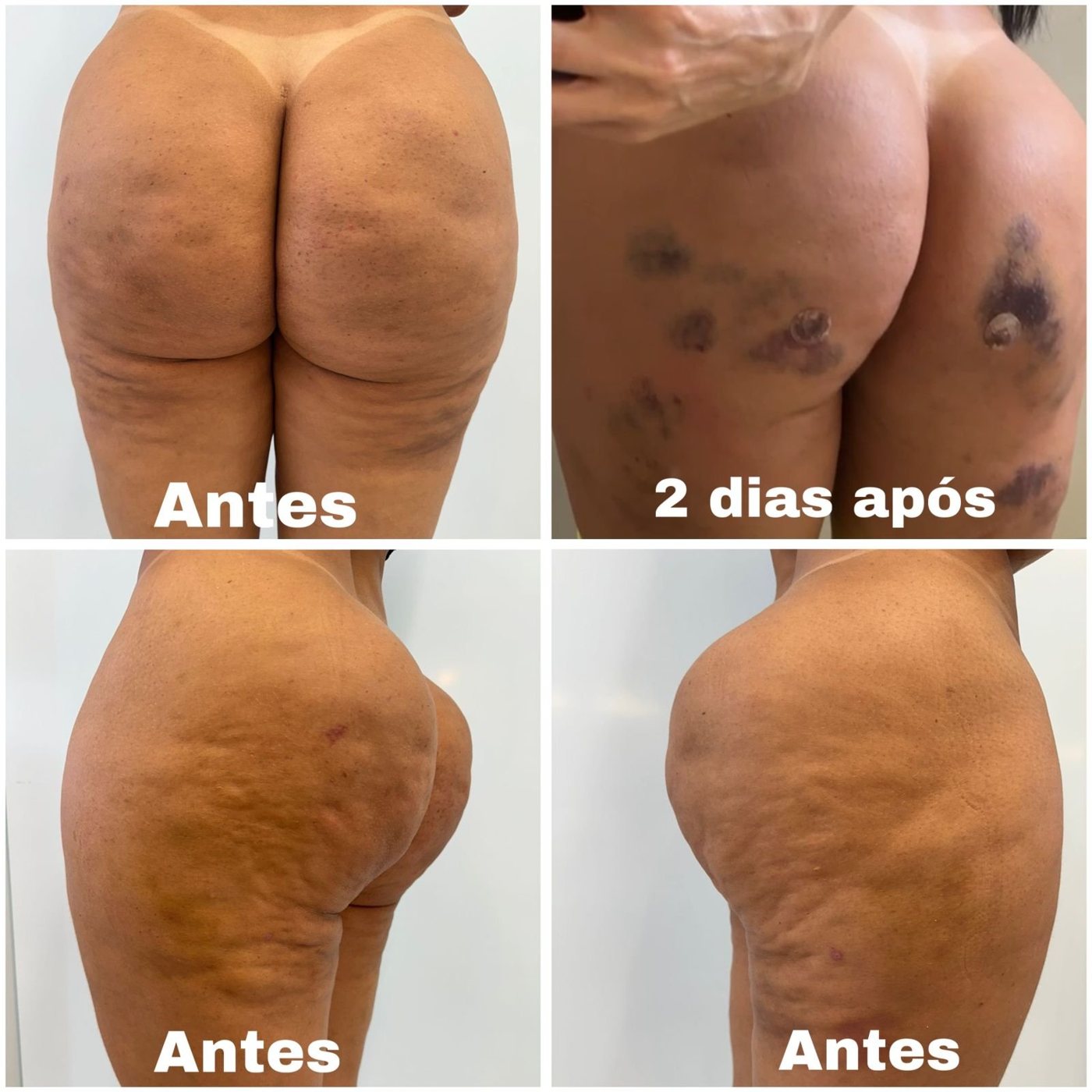 Subcision em celulite