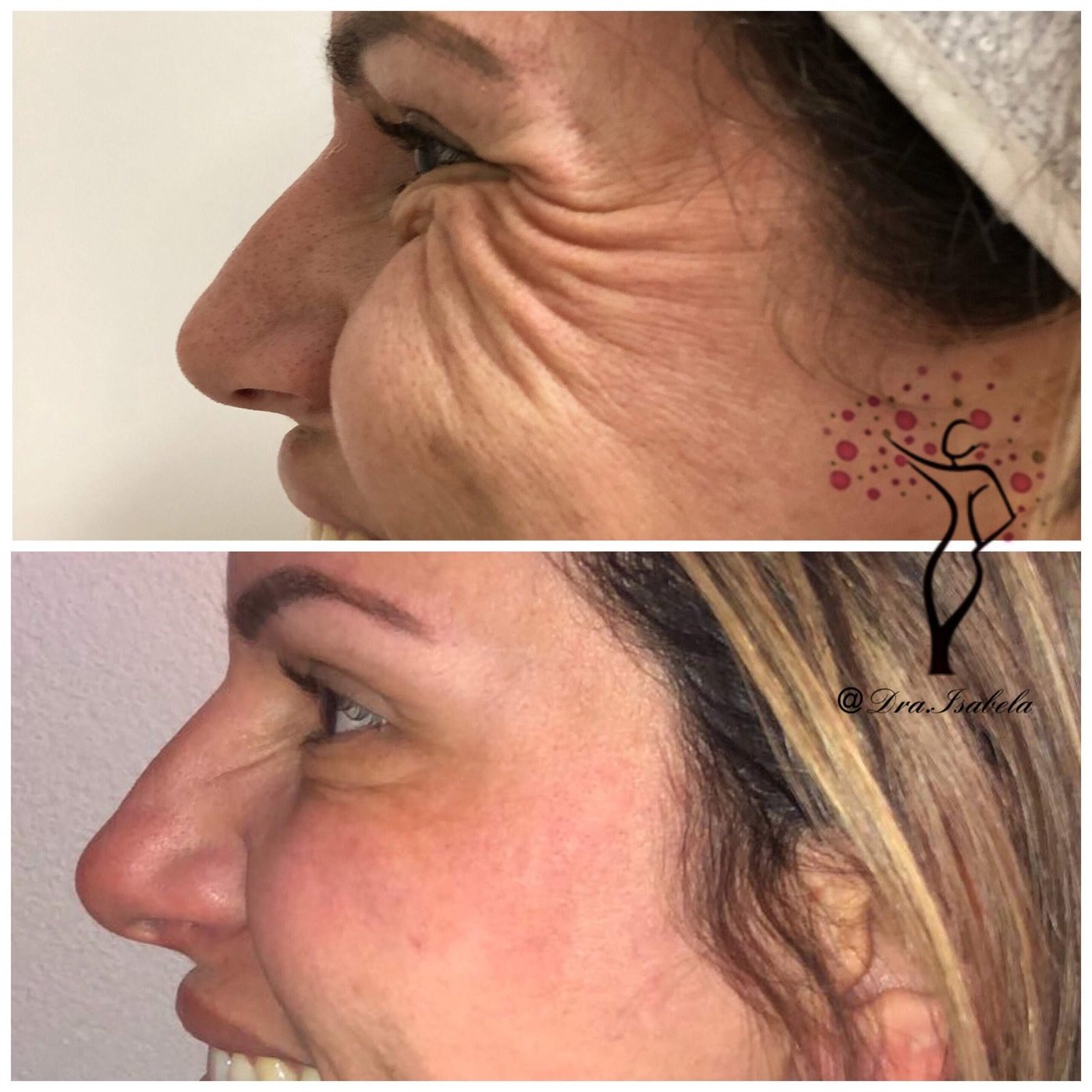 Toxina Botulínica (Botox)