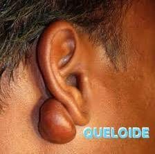 Tratamento de queloide